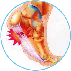 General Foot Pain – Plantar Fasciitis